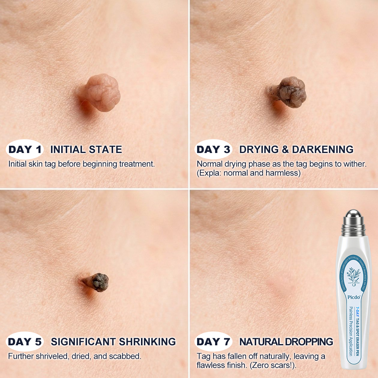 𝐏i𝐜𝐝o®7-𝐷𝑎𝑦 𝗧𝐚𝐠 & 𝗦𝗽𝐨𝐭 𝐄𝐫𝒂𝒔𝒆𝒓(Zero Pain, Zero 𝐒𝐜𝐚𝒓𝒔 Rollerball) 🌹🌹