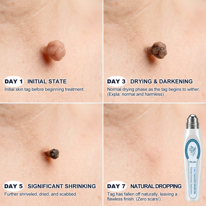 𝐏i𝐜𝐝o®7-𝐷𝑎𝑦 𝗧𝐚𝐠 & 𝗦𝗽𝐨𝐭 𝐄𝐫𝒂𝒔𝒆𝒓(Zero Pain, Zero 𝐒𝐜𝐚𝒓𝒔 Rollerball) 🌹🌹